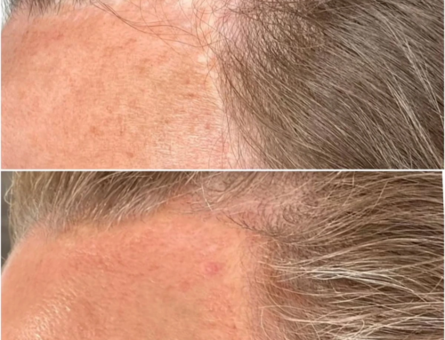 Scar Camouflage After Plastic Surgery in Palm Beach Gardens
