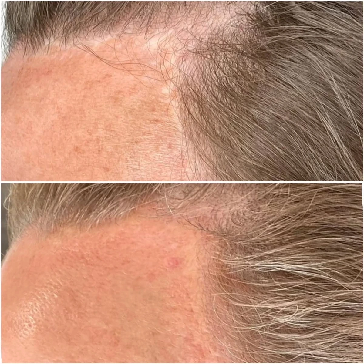 Facelift scar along the hairline before and after scar camouflage, showing reduced contrast with the surrounding skin